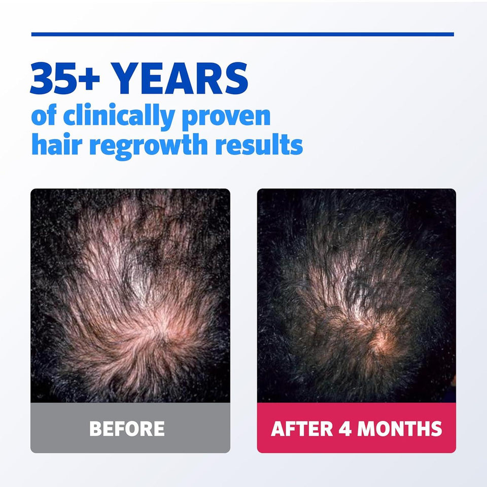Rogaine Extra Strength Mens Hair Regrowth Treatment 1 Month